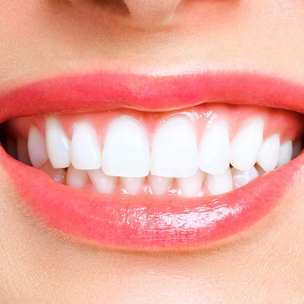 Clareamento Clareamento